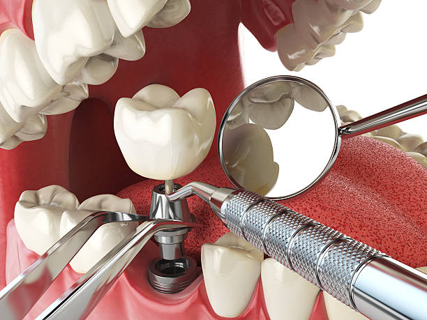 Best Chipped Tooth Repair Near Me  in Gardendale, TX